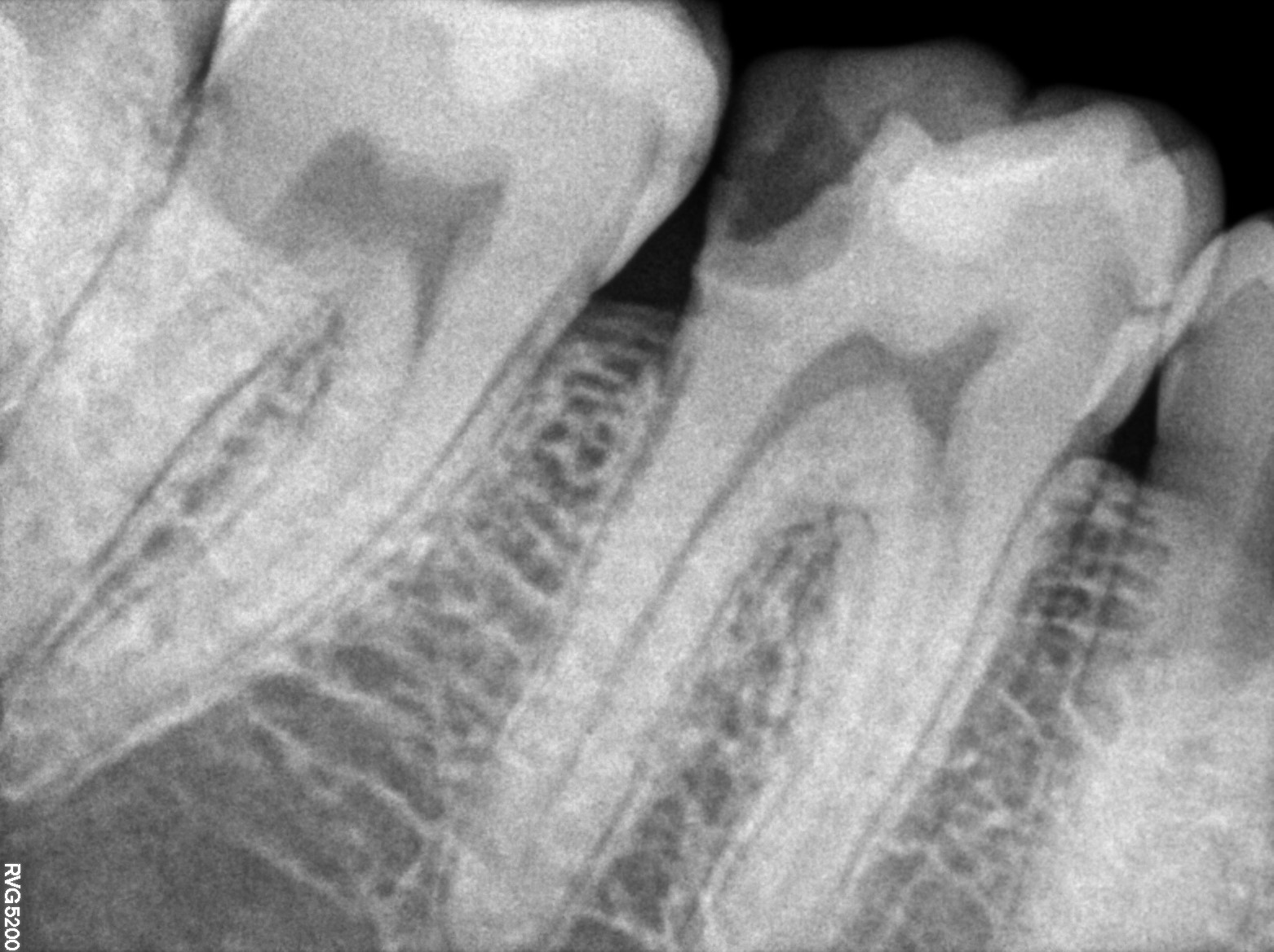 Dental X-ray